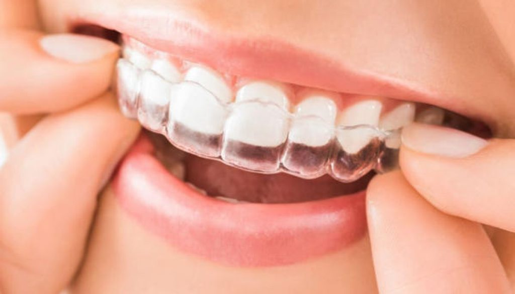 Niềng răng Invisalign được đánh giá là công nghệ chỉnh nha hiện đại bậc nhất trên thế giới hiện nay