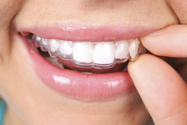 Niềng răng invisalign bao lâu thì có hiệu quả?